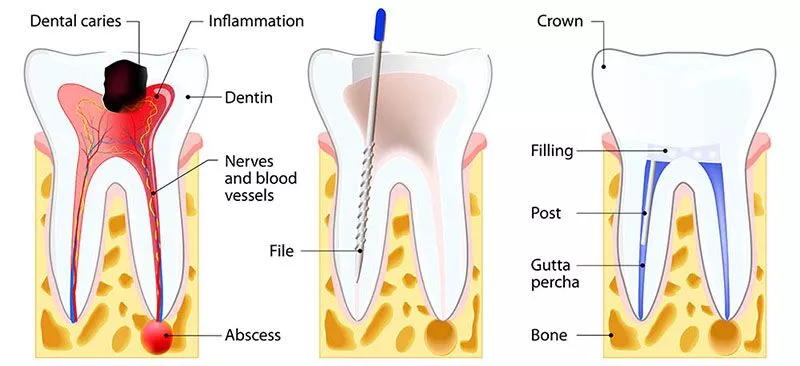Benefits of Root Canal