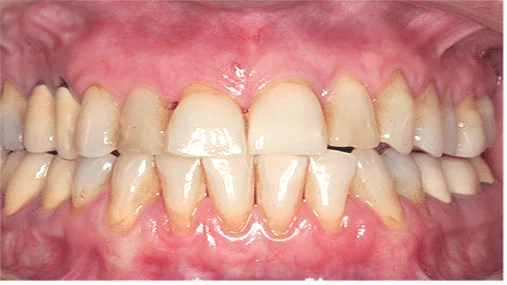After Periodontal Flap Surgery Treatment
