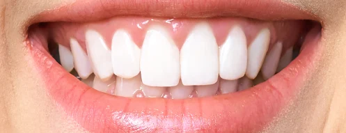 After Teeth Whitening Treatment